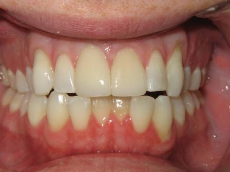 After Whitening and Veneers