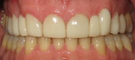 Teeth After Braces 