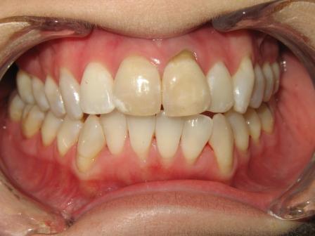 Before Veneers Before Veneers