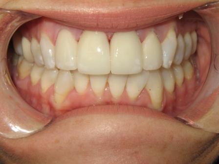 After Veneers After Veneers