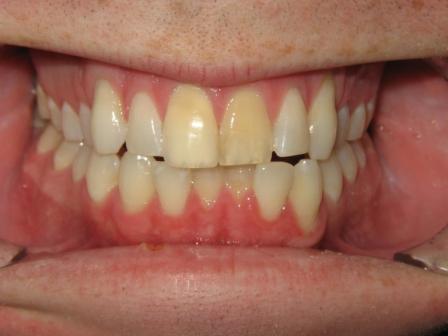 Before Whitening and Veneers Before Whitening and Veneers