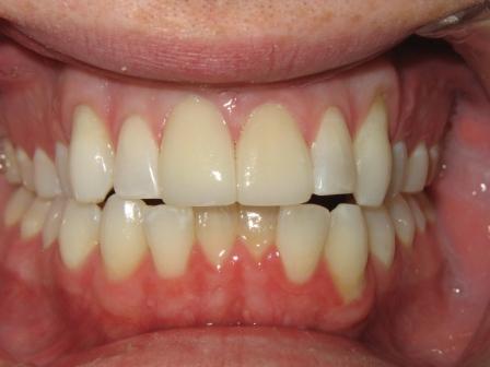 After Whitening and Veneers After Whitening and Veneers