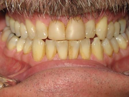 Before Treatment Before Treatment