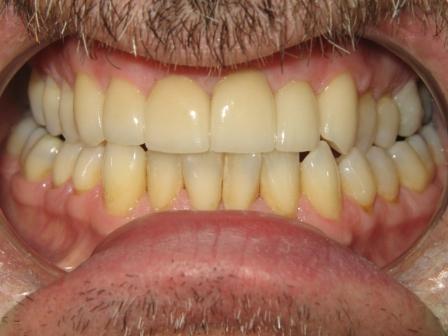 After Treatment After Treatment