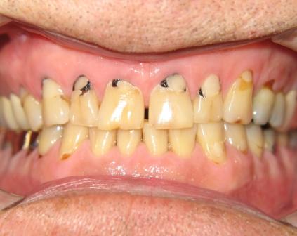 Teeth Before Treatment Teeth Before Treatment