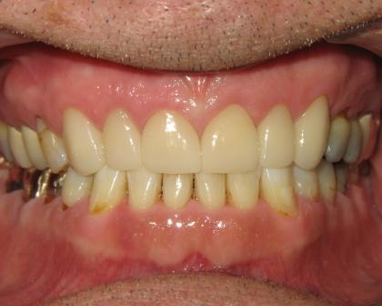 Teeth After Treatment Teeth After Treatment