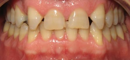 Teeth Before Braces Teeth Before Braces