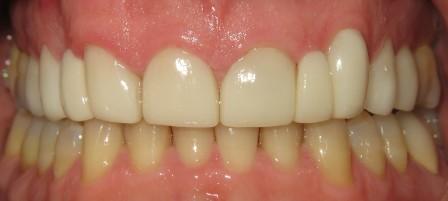 Teeth After Braces Teeth After Braces